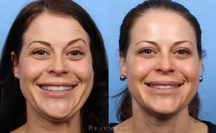 Botox for Crows Feet and Forehead