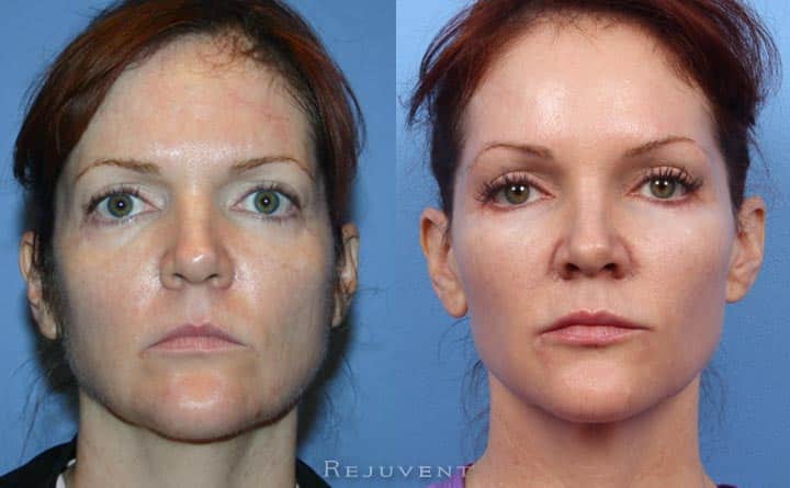 Liquid Facelift Long Term
