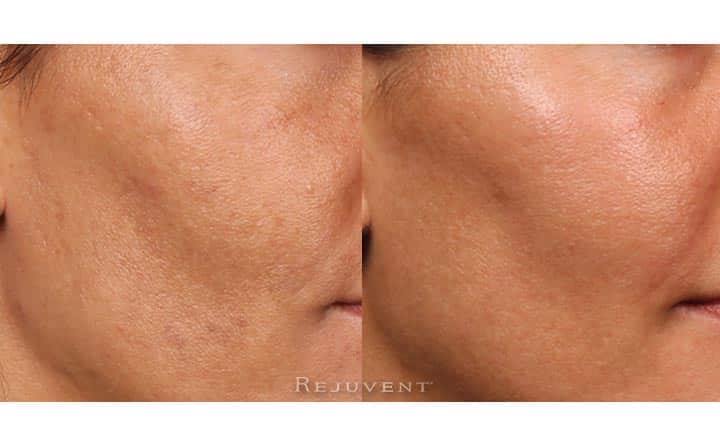 Melasma improvement