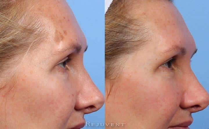 Lesion excision on forehead