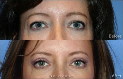 Eyelid surgery