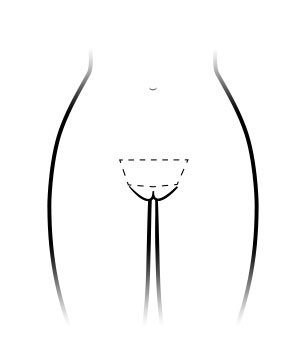 Mons Pubis area for ThermiVa Shaving