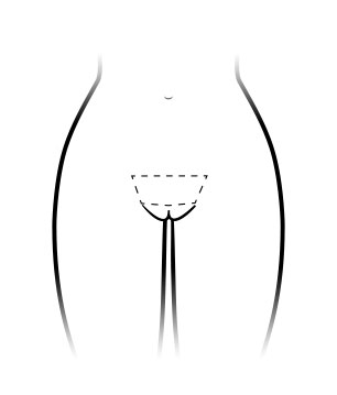 Mons Pubis area for ThermiVa Shaving