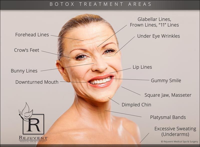 Natural results with Botox