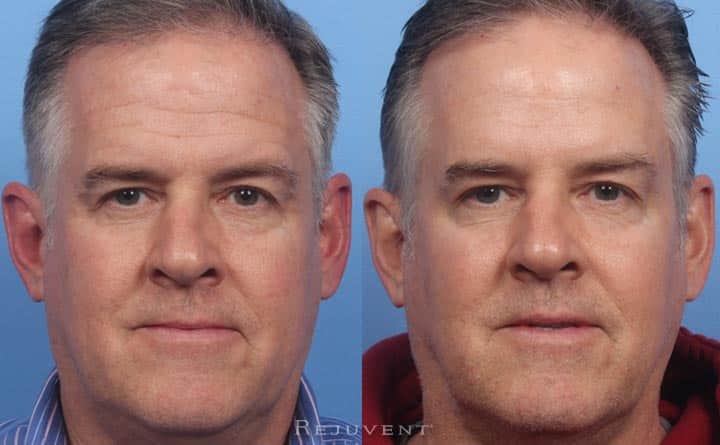 Dysport on forehead male results