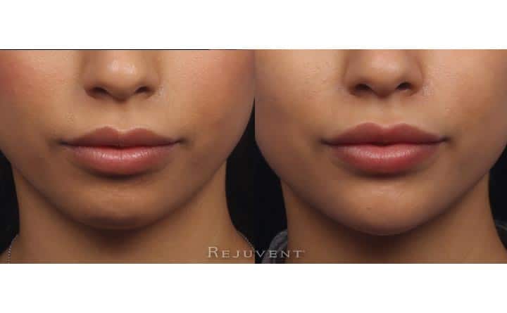 Chin sculpting non-surgical front view