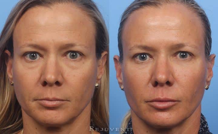 Refreshed and youthful Liquid Facelift Results Front