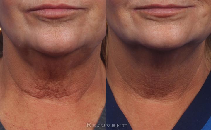 Neck rejuvenation with Dysport