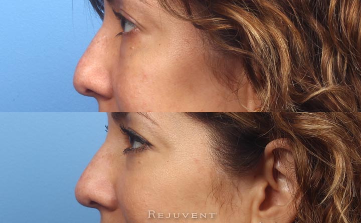 Non surgical nose job with dermal fillers