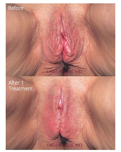 ThermiVa before and after