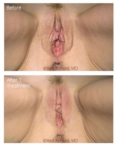 ThermiVa before and after photo 2