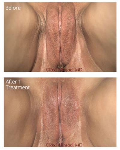 ThermiVa before and after photo 4