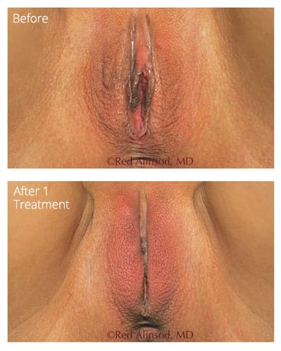 ThermiVa before and after photo 5
