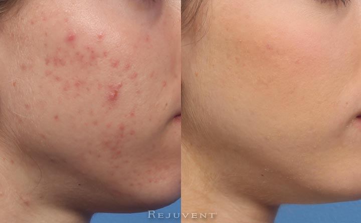 Acne Results after Treatment at Rejuvent