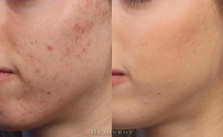 Acne Results Side 2