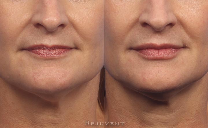 Natural appearing enhancement lips