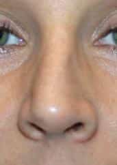 Crooked nose