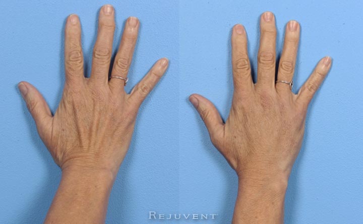 Hand Filler Beautiful results
