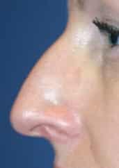 Hump nose with a prominent dorsal hump