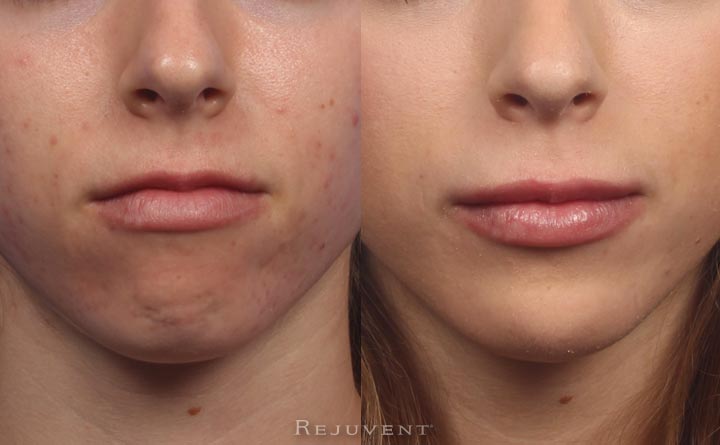 Beautiful Lips after Juvéderm and Volbella