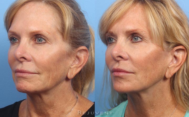 Natural Liquid Facelift Results three quarters view
