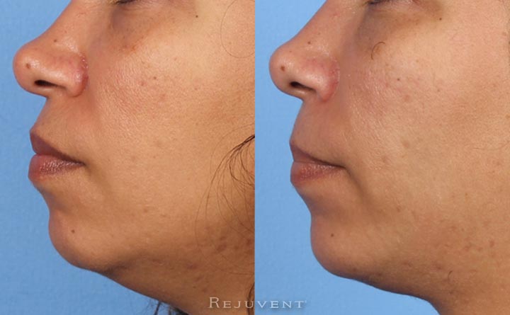 Improved Chin with Restylane Lyft