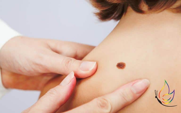skin cancer risks and what to do to prevent them