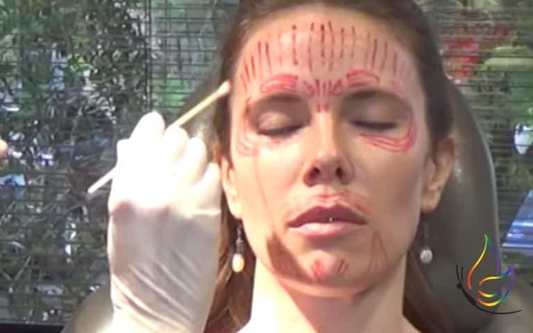 why we get natural botox results