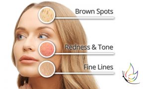 why you need a fotofacial