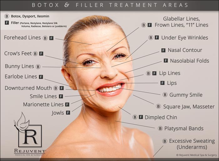 Botox and filler treatment areas