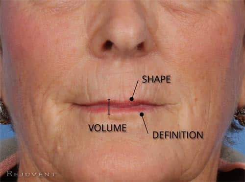 Lip Volume loss, shape and definition