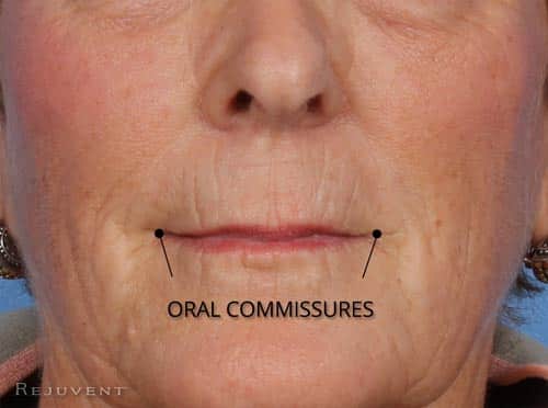 Oral Commissures changes with aging