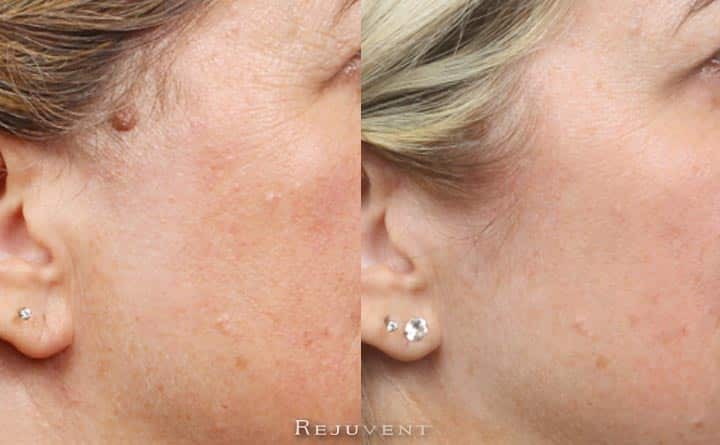 Chemical Peels, IPL and skin care, rejuvenated this patient