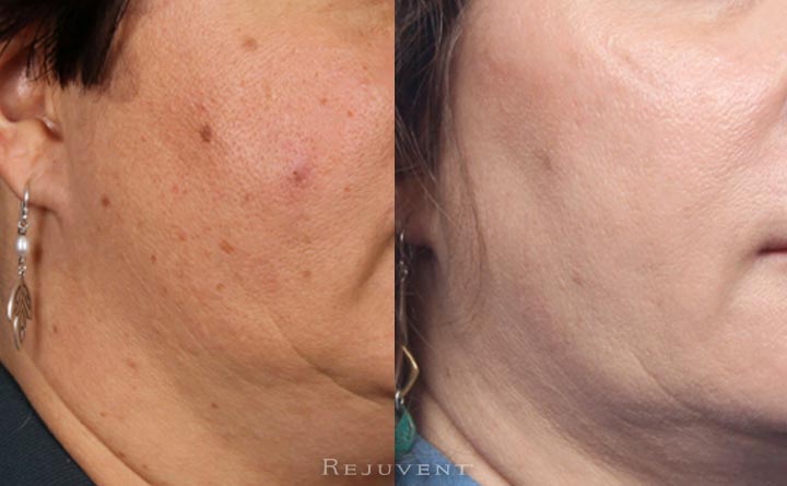 Aging skin rejuvenated after skin treatments