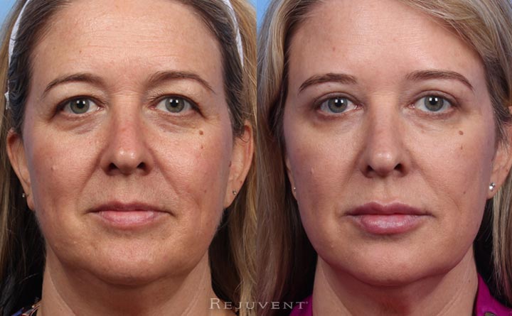 Under Eye Rejuvenation Photos â€¢ Rejuvent Medical Spa Scottsdale