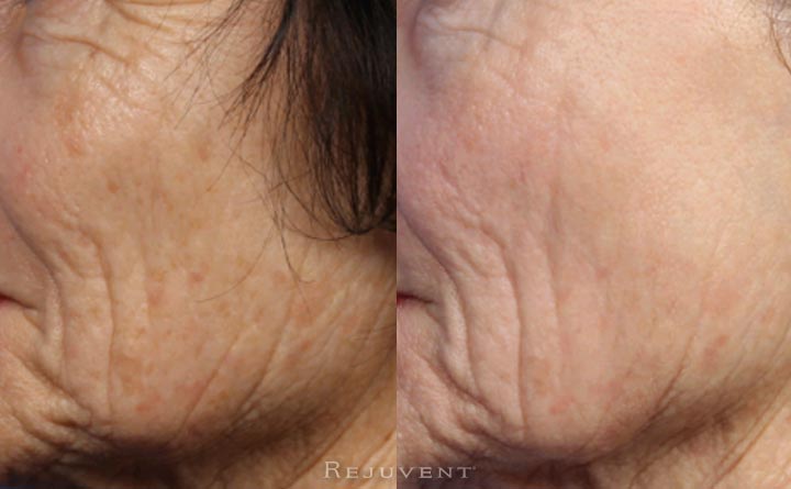 Levulan and IPL skin transformation