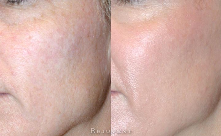 Levulan PDT before and after photo