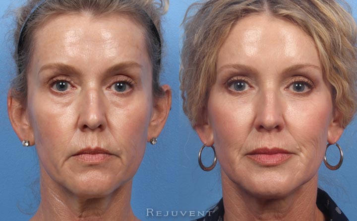 Liquid Facelift before and after transformation