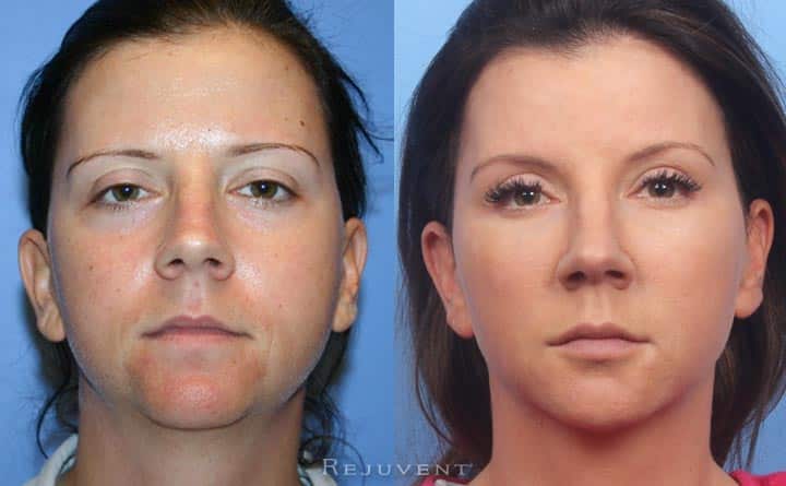 Liquid Facelift Long Term Results