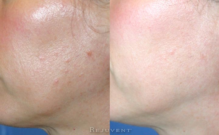 Tigther, Brighter, Better texture after skin treatments