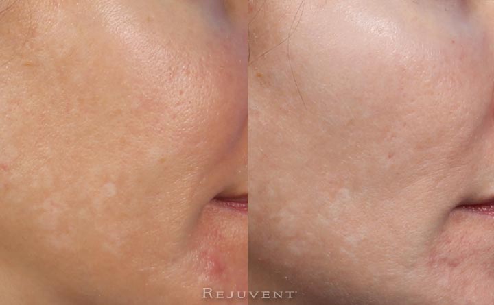 PRP Facial Before and After