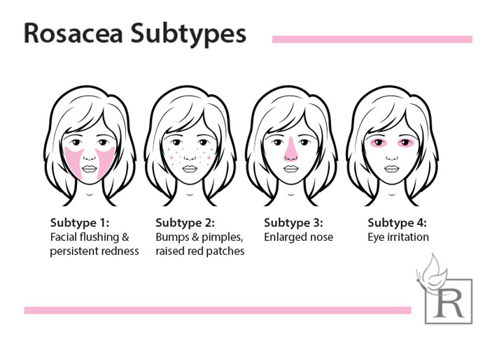 Rosacea treatment subtypes and areas