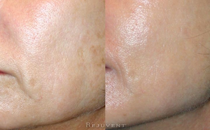 Skin Laxity Improvement