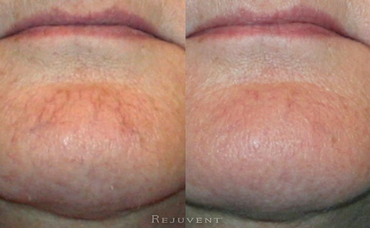 Veinwave spider vein results