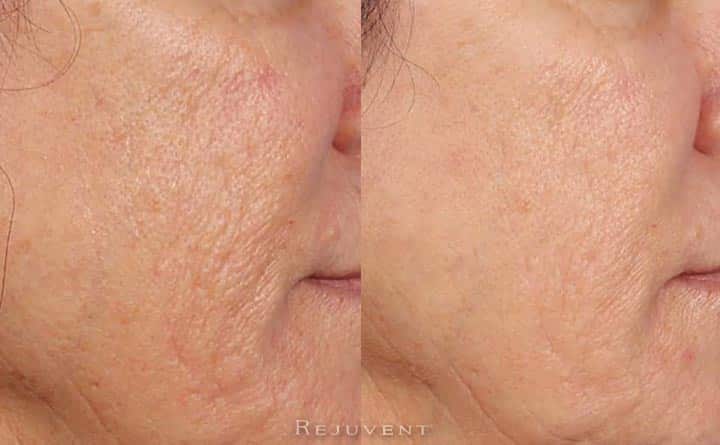 eMatrix Fractional Resurfacing