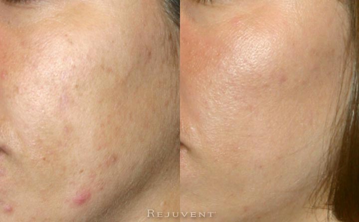 Acne and texture improvement