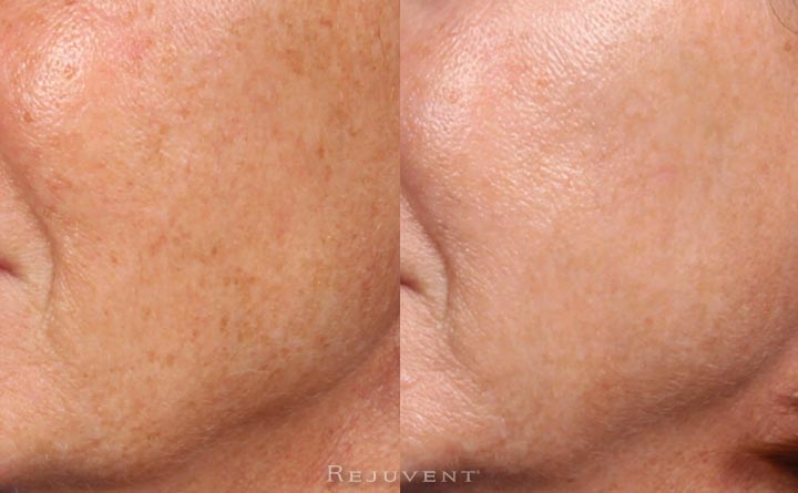 Improved pigmentation and skin texture