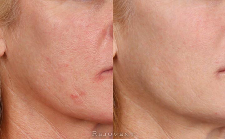 Beautiful and healthier skin after IPL, Peels and micro needling