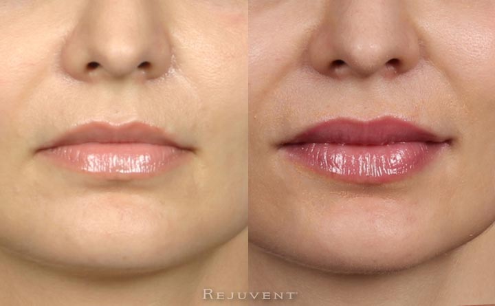 Beautiful Plump lips after lip filler injections