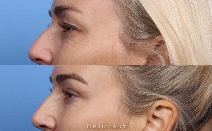 Upper and Lower Blepharoplasty at Rejuvent in Scottsdale